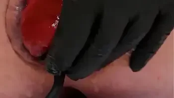 Contender For Biggest Prolapse (Male Warning!)