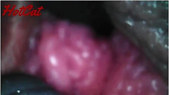Endoscopic Vaginal Observation